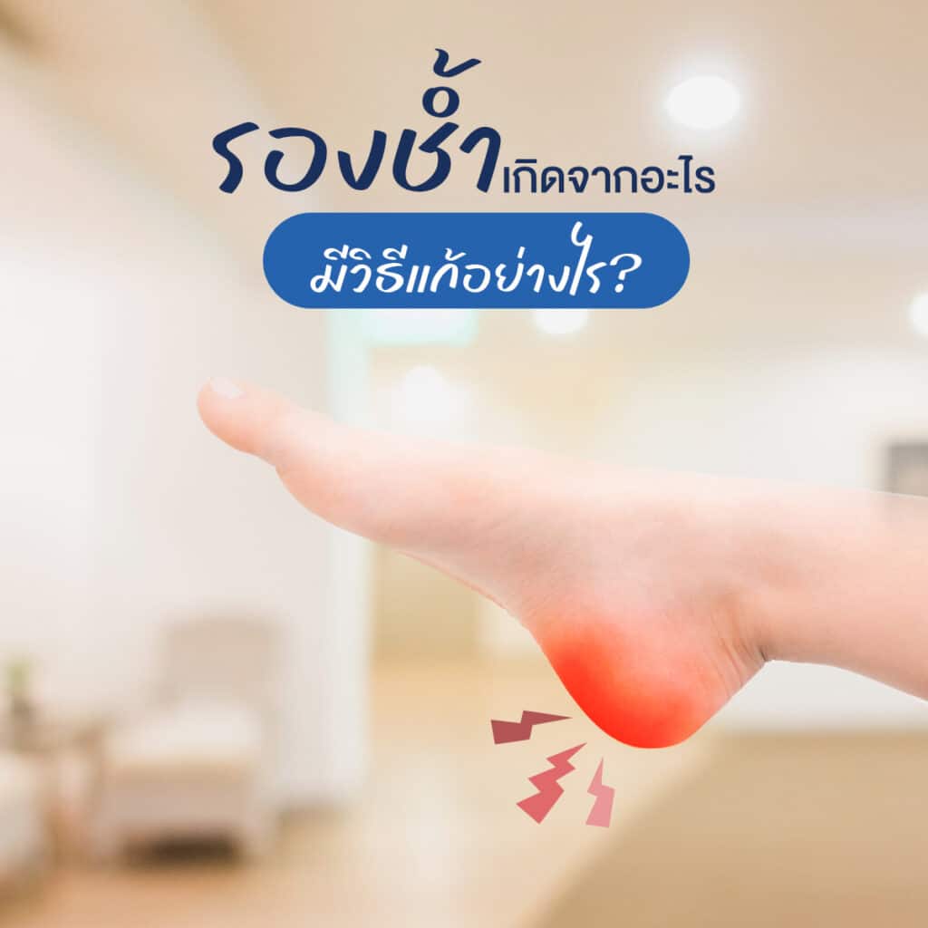 รองช้ำเกิดจากอะไร ? มีวิธีแก้อย่างไร ?
